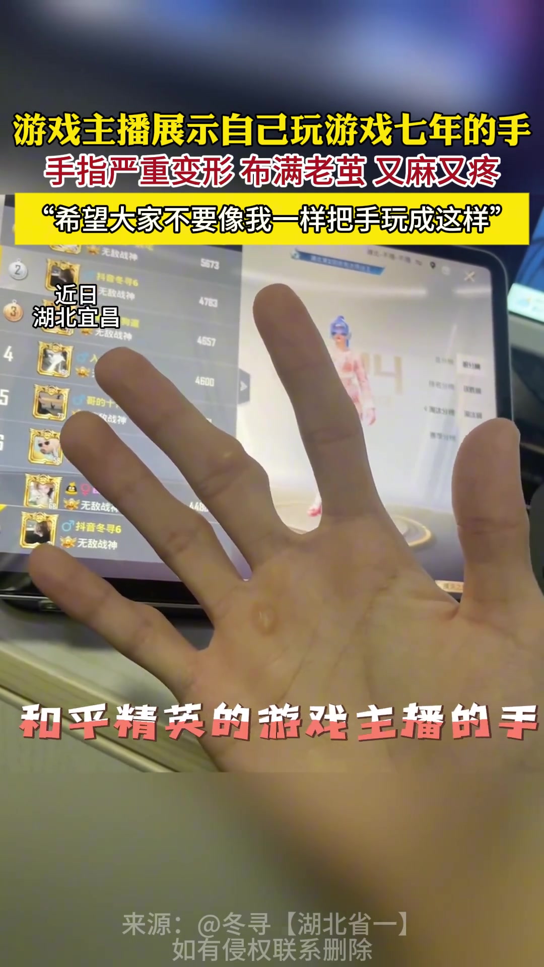 j9九游会老哥俱乐部交流游戏主播玩游戏7年手指严重变形：每天固定一个动作十几个小时